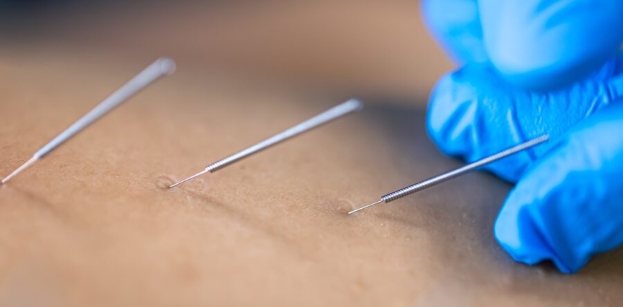 Dry Needling: Uncover the Benefits for Pain Management and Recovery