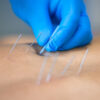 The Role of IMS and Dry Needling in Treating Muscle Strains