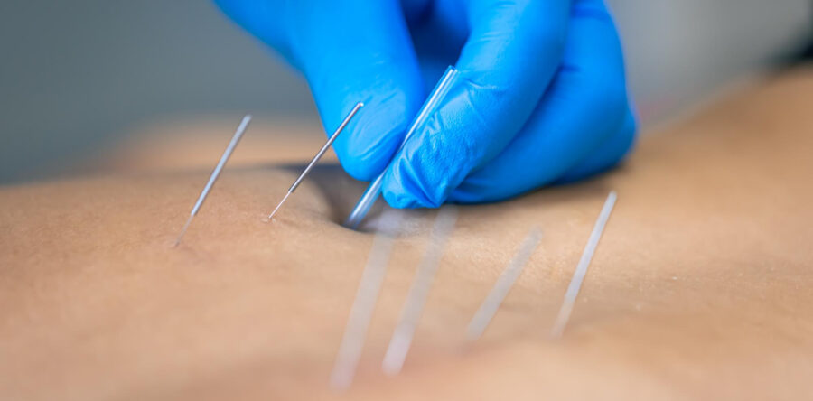 The Role of IMS and Dry Needling in Treating Muscle Strains